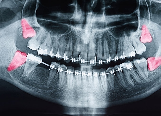 Головная боль и зубы: есть ли связь